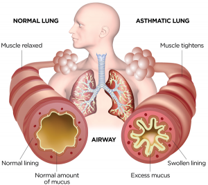 astma i homeopatija