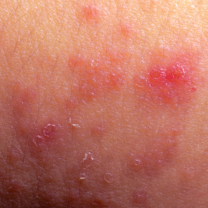 atopijski dermatitis